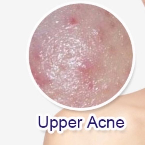 Anti acne whitening soap - Picture 5 of 7